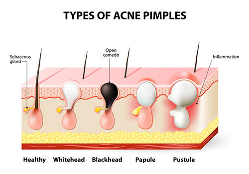 Acne Andover Dermatology Exceptional Skin Care Dermatology 