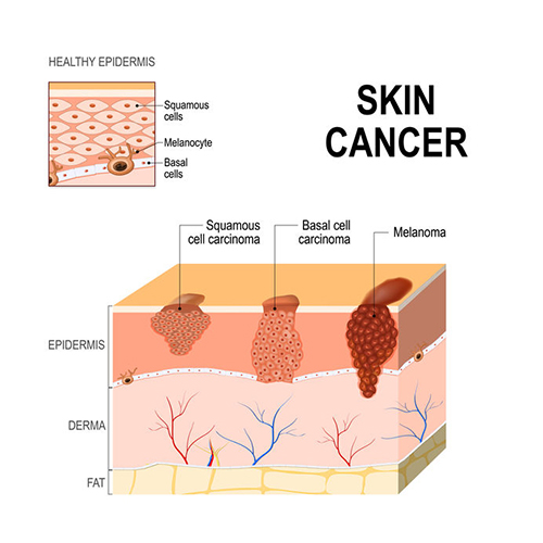 Skin Cancer Screening and Treatment - Andover Dermatology - Exceptional ...